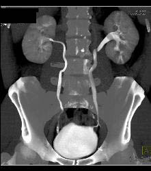 Normal CT Urogram - CTisus CT Scan