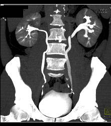 Normal CT Urogram - CTisus CT Scan