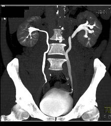 Normal CT Urogram - CTisus CT Scan