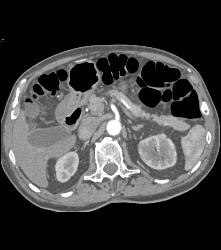 Left Hydronephrosis and Delayed Function Left Kidney Due to Distal Transitional Cell Cancer (TCC) - CTisus CT Scan