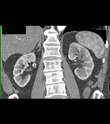 Left Hydronephrosis and Delayed Function Left Kidney Due to Distal Transitional Cell Cancer (TCC) - CTisus CT Scan