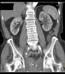 Left Hydronephrosis and Delayed Function Left Kidney Due to Distal Transitional Cell Cancer (TCC) - CTisus CT Scan