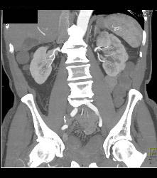 Left Hydronephrosis and Delayed Function Left Kidney Due to Distal Transitional Cell Cancer (TCC) - CTisus CT Scan