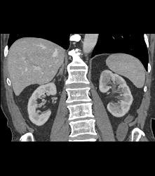 Left Hydronephrosis and Delayed Function Left Kidney Due to Distal Transitional Cell Cancer (TCC) - CTisus CT Scan