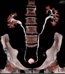 Retroperitoneal Fibrosis Displaces the Ureters - CTisus CT Scan