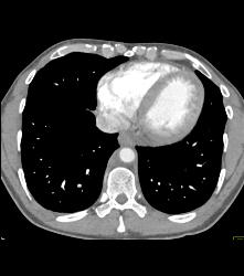 Retroperitoneal Fibrosis Displaces the Ureters - CTisus CT Scan