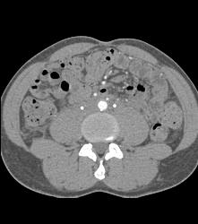 Retroperitoneal Fibrosis Displaces the Ureters - CTisus CT Scan