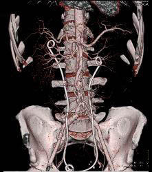 Retroperitoneal Fibrosis Displaces the Ureters - CTisus CT Scan