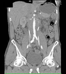 Retroperitoneal Fibrosis Displaces the Ureters - CTisus CT Scan