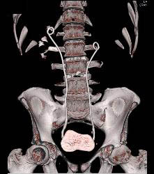 Retroperitoneal Fibrosis Displaces the Ureters - CTisus CT Scan