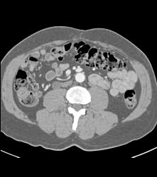 Retroperitoneal Fibrosis Displaces the Ureters - CTisus CT Scan