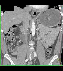 Retroperitoneal Fibrosis Displaces the Ureters - CTisus CT Scan