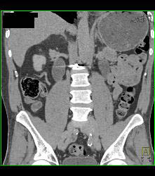 Retroperitoneal Fibrosis Displaces the Ureters - CTisus CT Scan