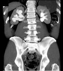 Retroperitoneal Fibrosis Displaces the Ureters - CTisus CT Scan