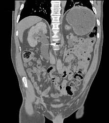 Retroperitoneal Fibrosis Displaces the Ureters - CTisus CT Scan