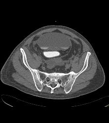 Leak From Bladder on CT Cystogram - CTisus CT Scan