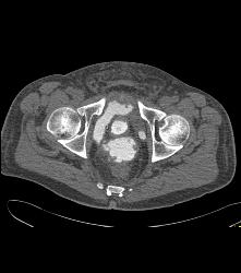 Leak From Bladder on CT Cystogram - CTisus CT Scan