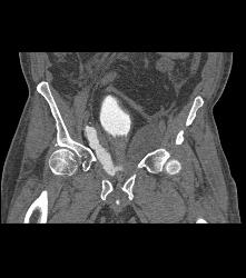 Leak From Bladder on CT Cystogram - CTisus CT Scan