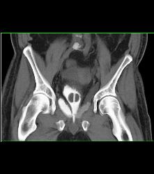 Leak From Bladder on CT Cystogram - CTisus CT Scan