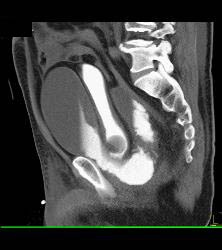 Leak From Bladder on CT Cystogram - CTisus CT Scan