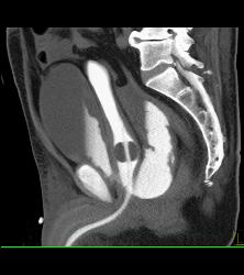 Leak From Bladder on CT Cystogram - CTisus CT Scan