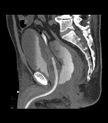 Leak From Bladder on CT Cystogram - CTisus CT Scan