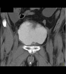 Leak From Bladder on CT Cystogram - CTisus CT Scan