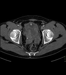 Prostate Sarcoma - CTisus CT Scan