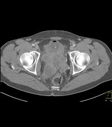 Prostate Sarcoma - CTisus CT Scan