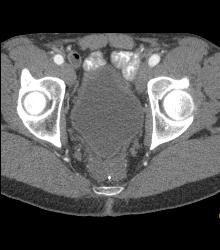 Prostate Simulates A Mass S/p Ap Resection - CTisus CT Scan