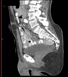 Prostate Simulates A Mass S/p Ap Resection - CTisus CT Scan