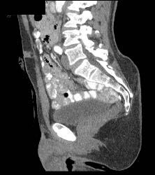 Prostate Simulates A Mass S/p Ap Resection - CTisus CT Scan