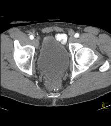 Prostate Simulates A Mass S/p Ap Resection - CTisus CT Scan