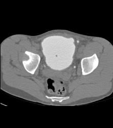 CT Cystogram With Reflux Into Ureters of Transplant Kidneys - CTisus CT Scan