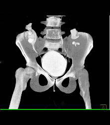 CT Cystogram With Reflux Into Ureters of Transplant Kidneys - CTisus CT Scan