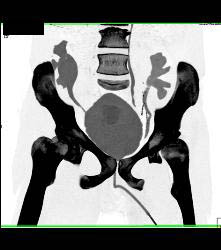 CT Cystogram With Reflux Into Ureters of Transplant Kidneys - CTisus CT Scan