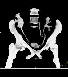 CT Cystogram With Reflux Into Ureters of Transplant Kidneys - CTisus CT Scan