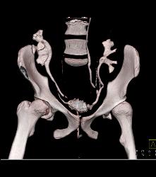 CT Cystogram With Reflux Into Ureters of Transplant Kidneys - CTisus CT Scan