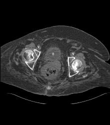 CT Cystogram With Reflux Into Ureters of Transplant Kidneys - CTisus CT Scan