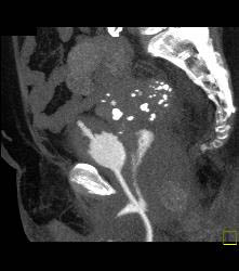 CT Cystogram With Reflux Into Ureters of Transplant Kidneys - CTisus CT Scan