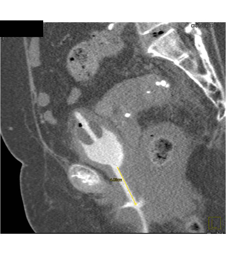 Bladder Fistulae - CTisus CT Scan