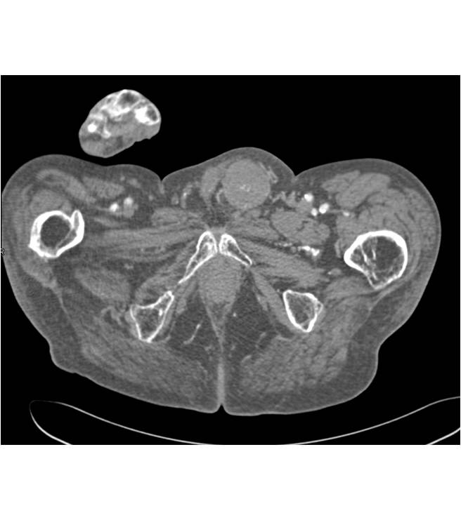 Lymphoma of the spermatic cord - CTisus CT Scan