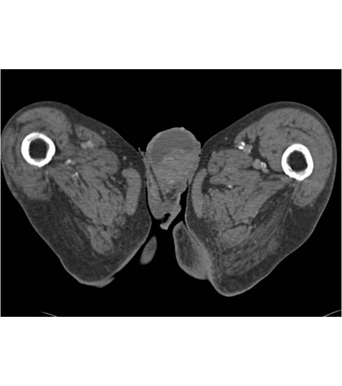 Hydrocele - CTisus CT Scan