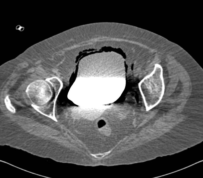 Emphysematous Cystitis - Genitourinary Case Studies - CTisus CT Scanning