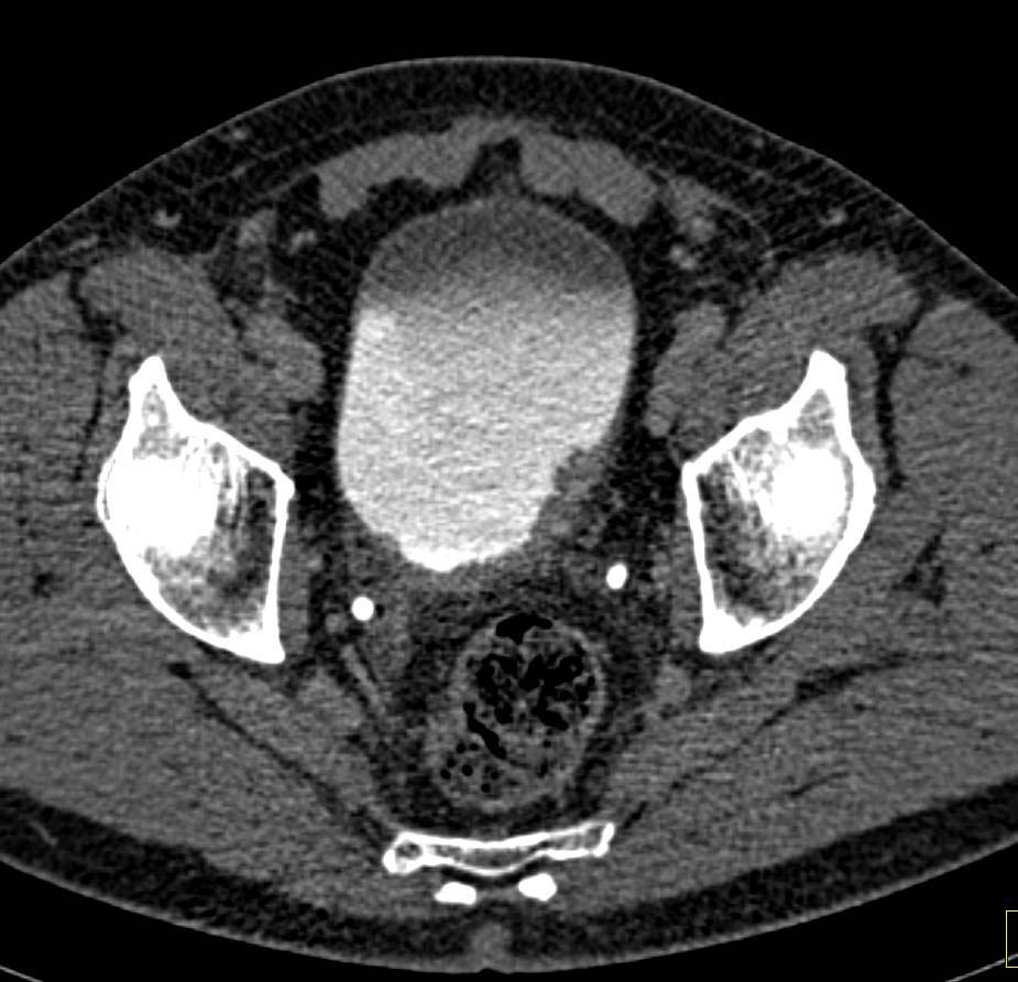 Bladder Cancer on Left Wall of Bladder - CTisus CT Scan