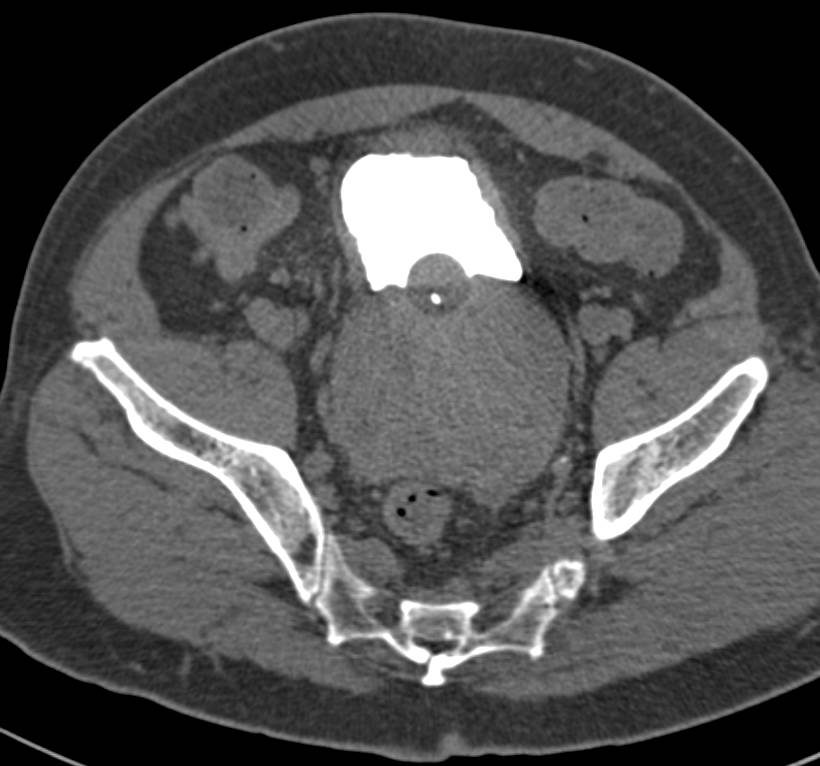 Sarcoma of the Prostate - CTisus CT Scan