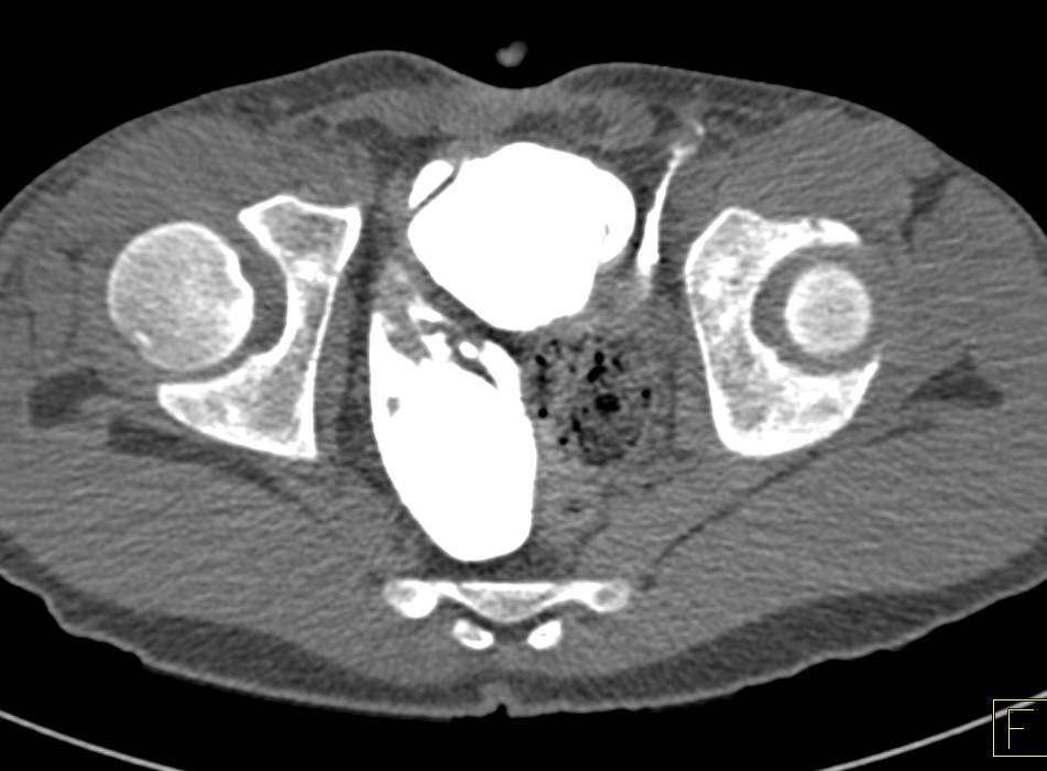 Bladder Perforation with CT Cystogram - CTisus CT Scan