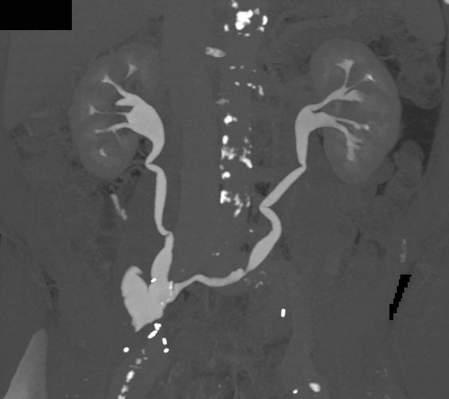 CT Urogram with Ileal Loop - CTisus CT Scan