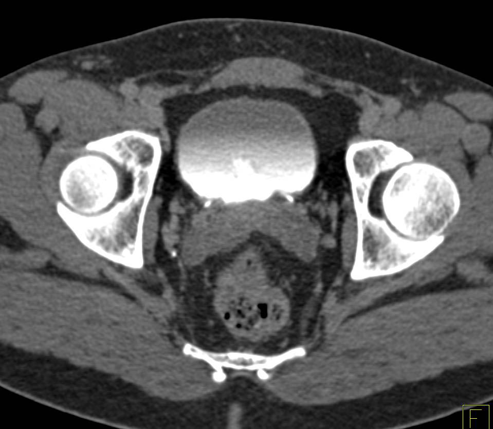 Enlarged Prostate - CTisus CT Scan