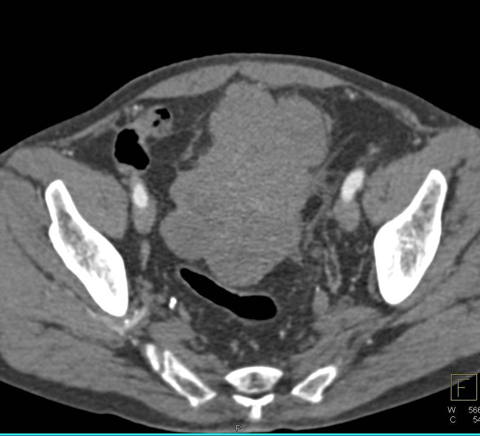 Aggressive Bladder Cancer - CTisus CT Scan